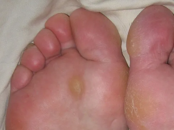Sole of a foot with a callus